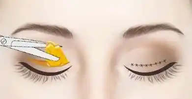 怎样快速获得自然双眼皮？这些方法安全又有效