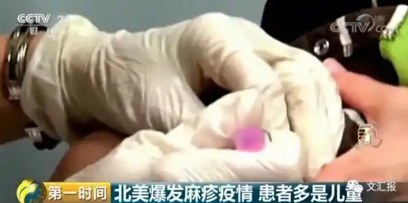 多国“爆发”麻疹 菲律宾至少203人死亡,美国确诊超167万